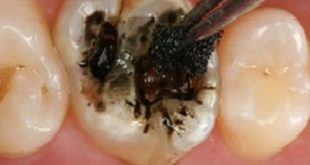 تسوس الأسنان