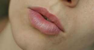 التخلص من السواد حول الفم