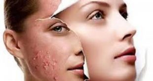 علاج حب الشباب