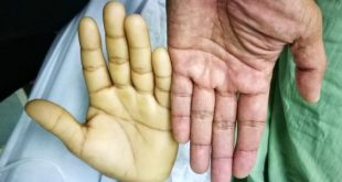 أسباب فقر الدم