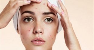 التخلص من حب الشباب