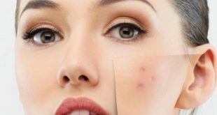 بقع الوجه السوداء